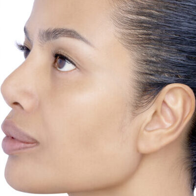 1. 레이저 토닝 After Image