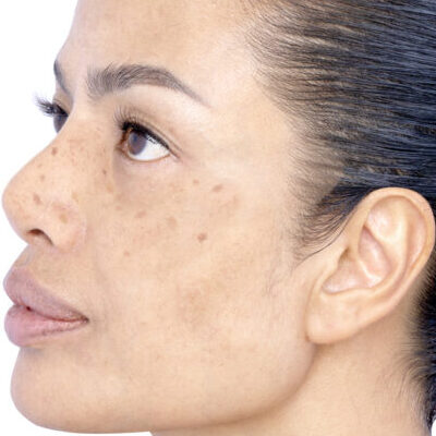 1. 레이저 토닝 Before Image