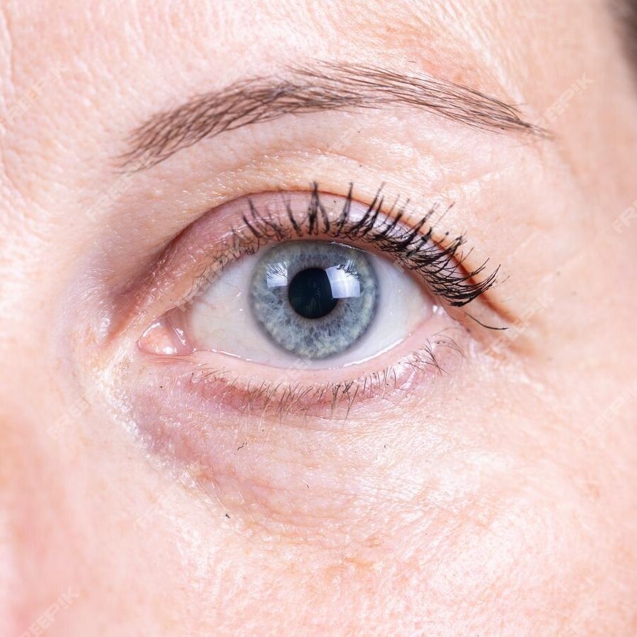 1. 보톡스 After Image