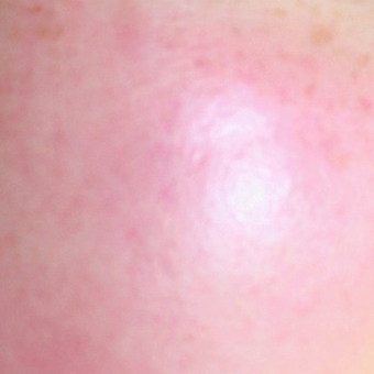 1. <b style='color: #2e2e2e;'>유별난 내 피부</b> <span style='color: orangered'>울긋울긋 안면홍조</span> (모세혈관확장증) After Image