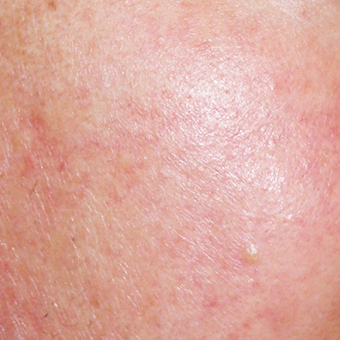 1. <b style='color: #2e2e2e;'>유별난 내 피부</b> <span style='color: orangered'>울긋울긋 안면홍조</span> (모세혈관확장증) Before Image
