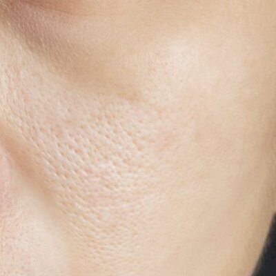 2. 레이저 토닝 After Image